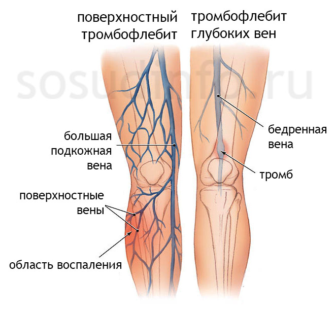 Тромбофлебит поверхностных и глубоких вен