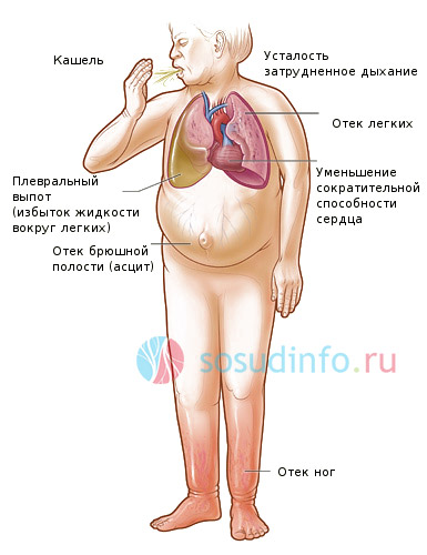 общие симптомы сердечной недостаточности