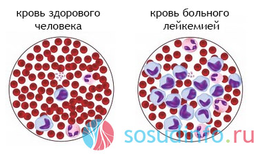 лейкемия, лейкоз