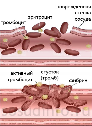 Образование тромба