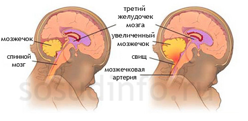 Здоровый мозжечок (слева) и мальформация Киари (справа)