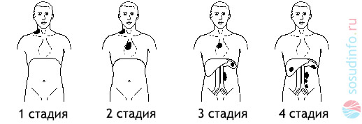 стадии лимфомы и области поражения