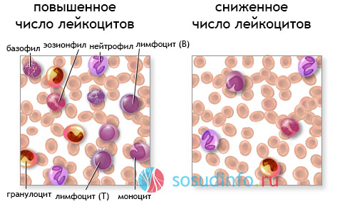 лейкоз и лейкопения