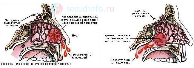 Переднее (слева) и заднее (справа) носовые кровотечения