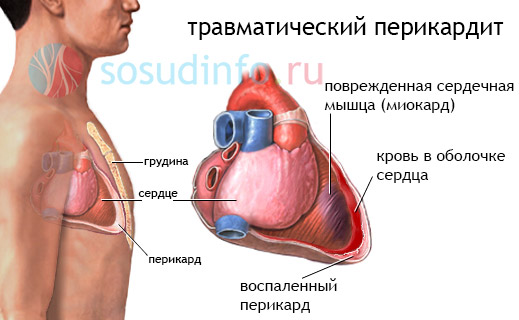 тампонада и перикардит из-за травмы