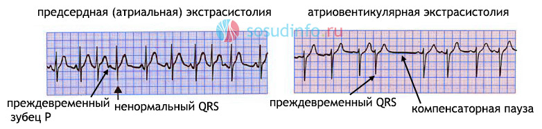 наджелудочковые экстрасистолии на ЭКГ