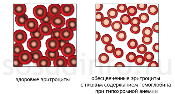 гипохромная анемия