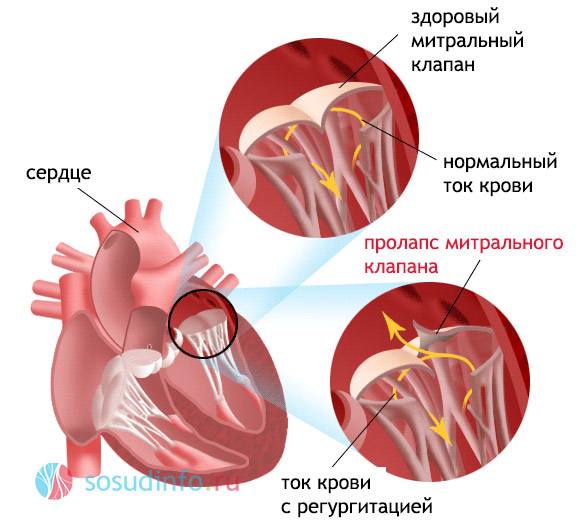 пролапс митрального плапана