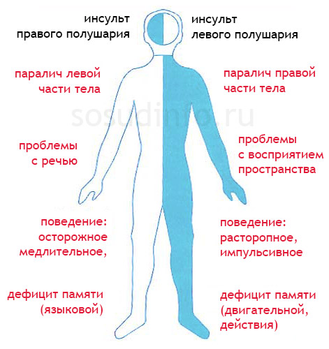 Инсульт левой и правой стороны