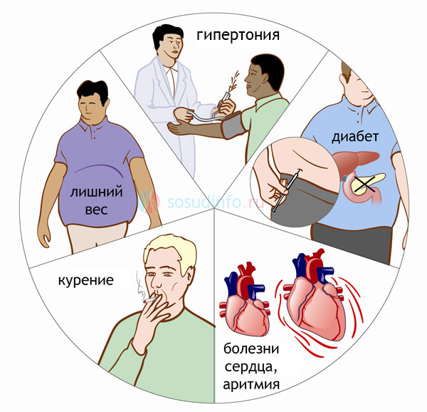 Ключевые факторы риска инсульта