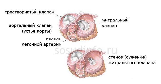 Митральный клапанный стеноз