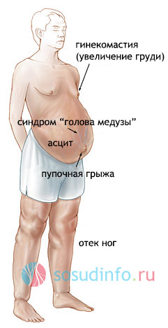 симптомы существенной портальной гипертензии
