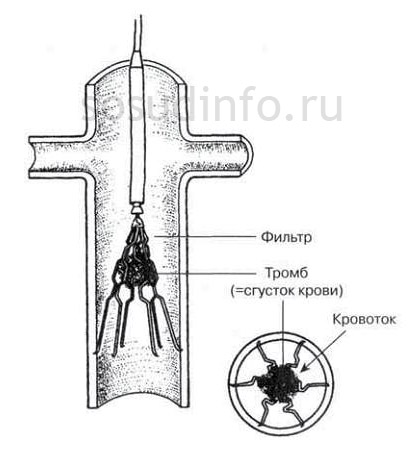 Установка кава (IVC) фильтра при тромбозе