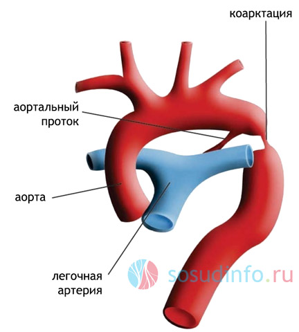 сильная степень коарктации (сужения) аорты, чреватая осложнениями