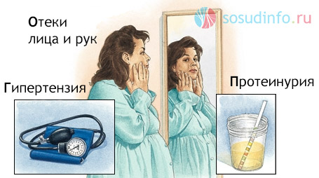 Симптомы гестоза