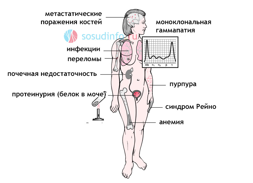 симптомы миеломы