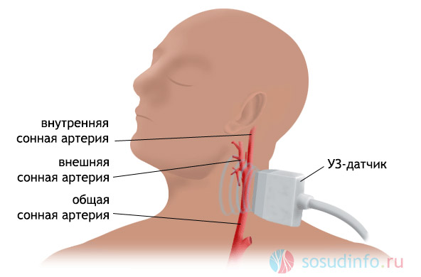 Ультразвуковое исследование БЦА на примере сонных артерий