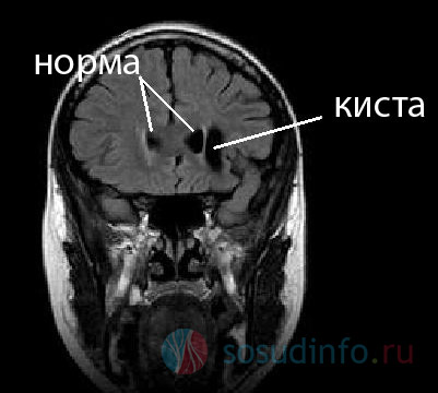 ретроцеребеллярная (внутримозговая) киста
