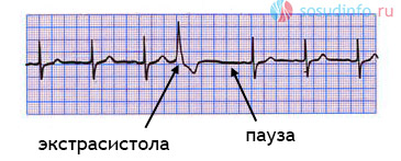 желудочковая экстрасистолия на ЭКГ