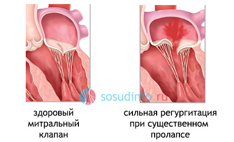 пролапс митрального плапана