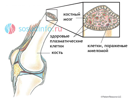миелома