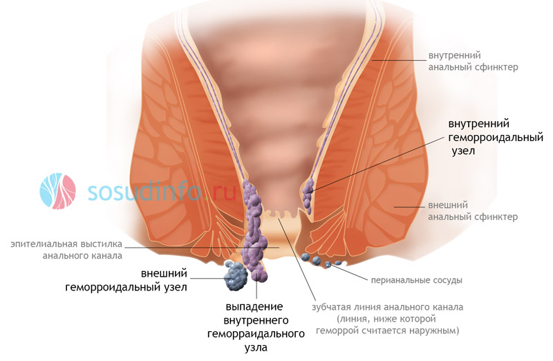геморрой