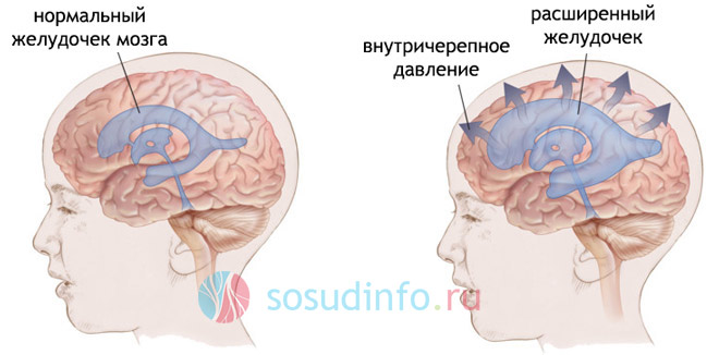 гидроцефалия