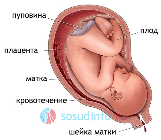 отслоение плаценты