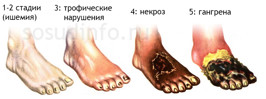 Эндартериит: стадии болезни