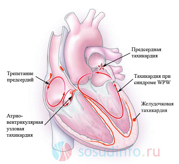 Локализации источников тахикардий
