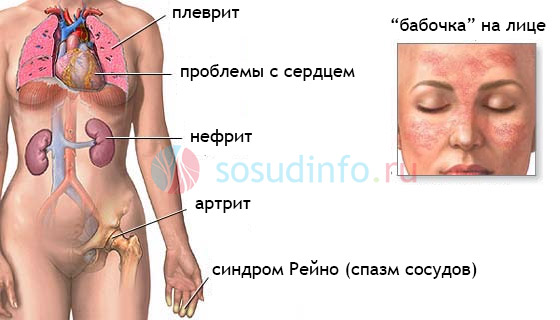 Проявления и осложнения системной волчанки.