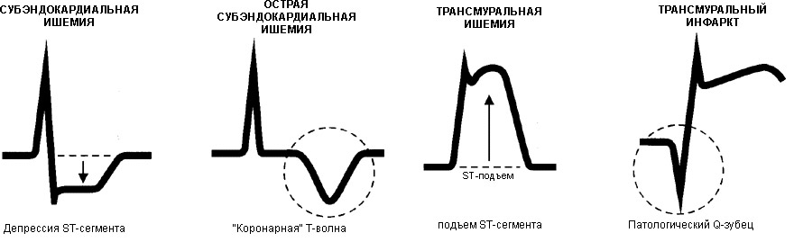 различные формы и степени ишемических изменений на ЭКГ