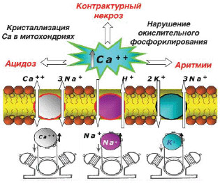 схема перегрузки кардиомиоцитов ионами кальция