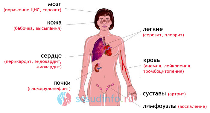 осложнения системной красной волчанки