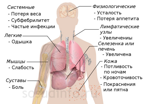 симптомы лейкоза