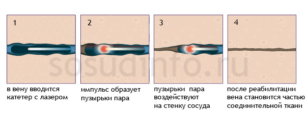 Лазерная флебэктомия (лазерная коагуляция)